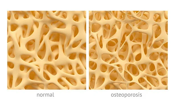 osteoporosis_interna.webp (89 KB)